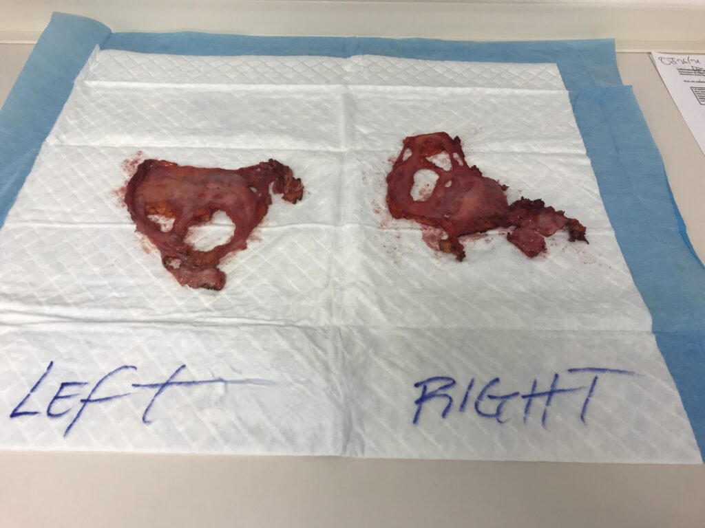 Capsules résiduelles