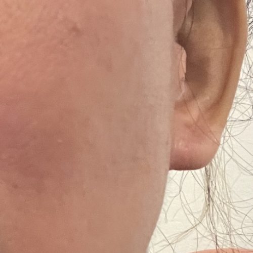 2 days post explantation