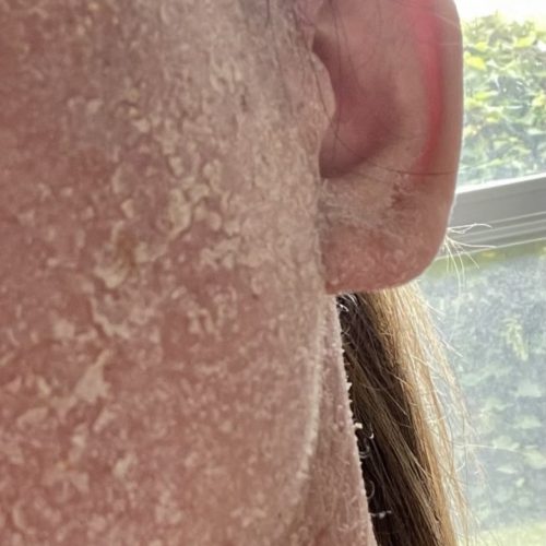 Severe eczema following implantation